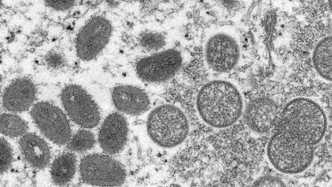 台湾完成当地首宗猴痘个案的病毒基因排序。AP资料图片