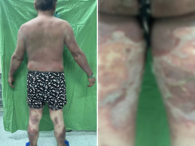 澎湖一名70岁男子接种新冠疫苗后，出现全身脱皮不良反应。网图