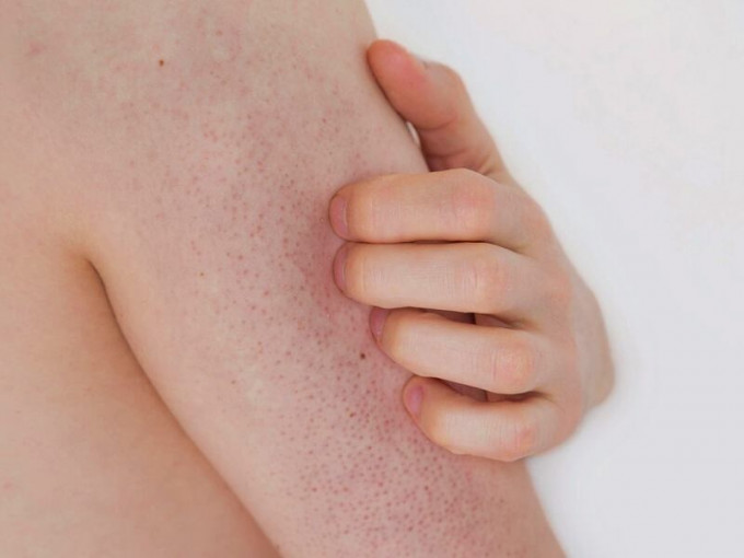 皮肤起「粒粒」可能是毛孔角化。