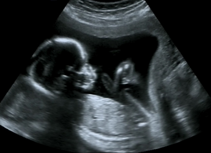 超聲波檢查能發現胎兒是否患愛德華氏症，故周醫生指產前做足檢查，非常重要。圖為資料圖片。