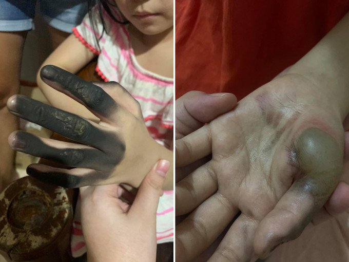 女童4指被燒黑，手掌起大水泡。（網圖）