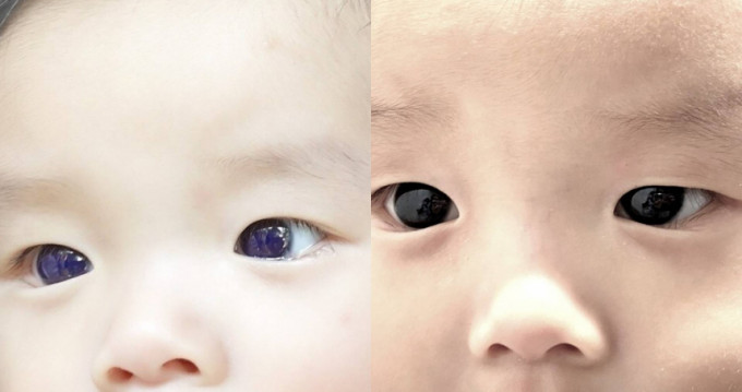 泰國男嬰服法匹拉韋後眼珠一度變藍，停藥5天後再次變回深棕色。網上圖片