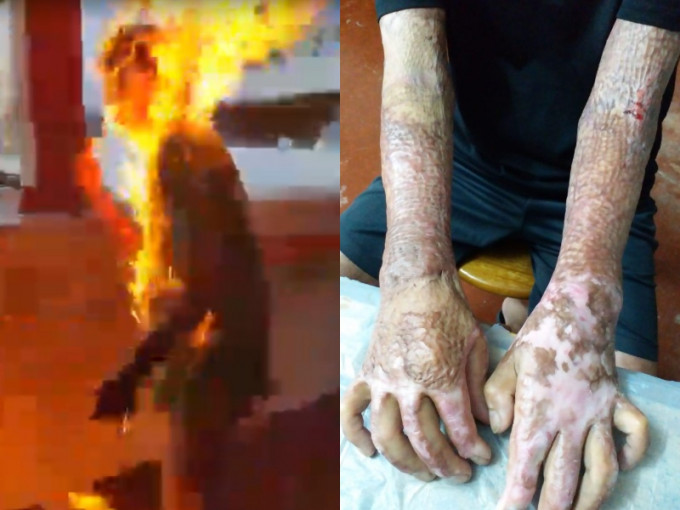 被火烧李生双手仍疼痛需要服止痛药。