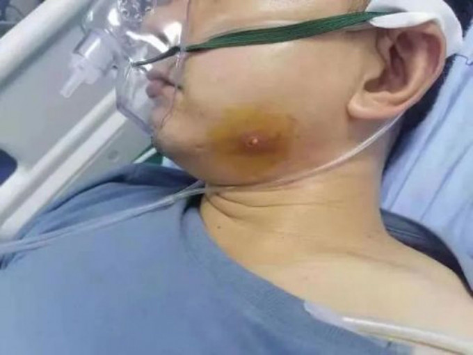 湖南26歲男擠暗瘡後 呼吸衰竭患敗血症及尿毒症。