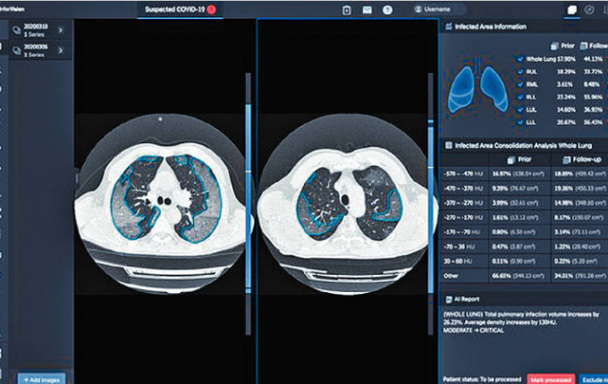 InferVision的肺炎电脑扫描比较受感染的肺部变化，并且数量化肺部的感染。