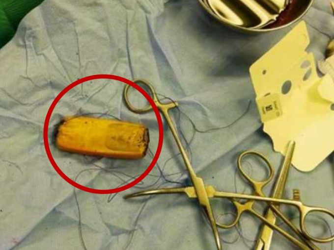 埃及男腹痛入院，醫生從肚裏拿出半年前吞下手機。網圖