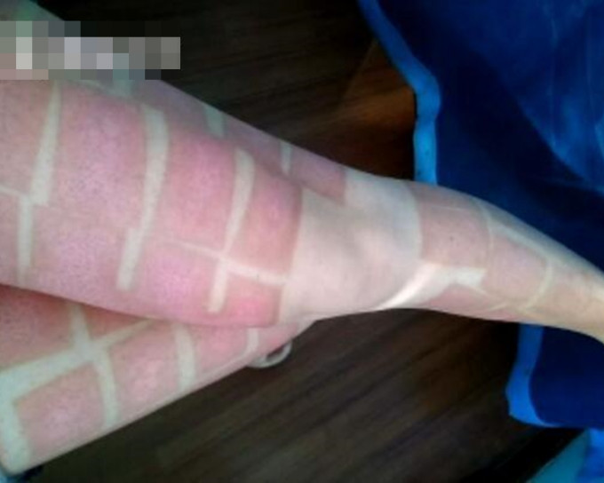 重慶一名女子經常起雞皮，醫生為她進行激光治療，結果雙腳起了一塊塊紅斑，變成「斑馬腿」。網圖