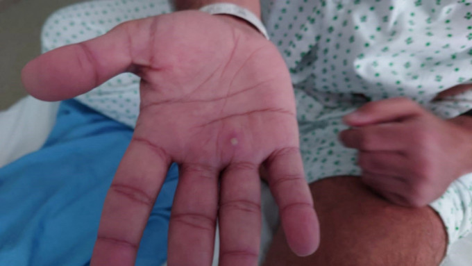 一名34岁男子确诊猴痘，其中一名密切接触者曾到韩国及台湾外游。资料图片
