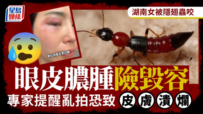 湖南女子证实隐翅虫皮炎症。