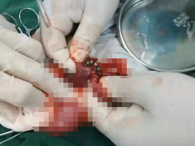 医生动手术取出男婴腹中的磁力珠。（网图）