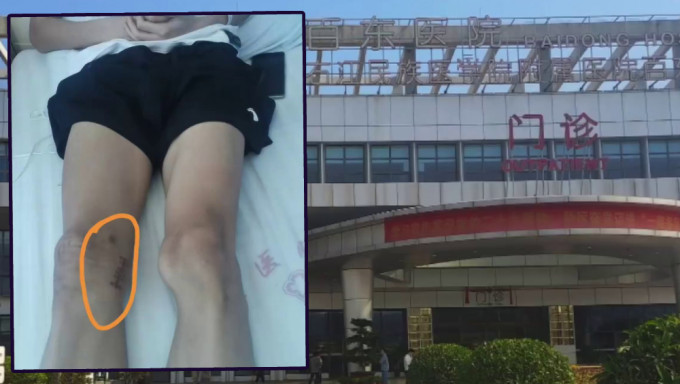 廣西17歲田徑健兒左腿長瘤右腿挨刀，6人被處理。
