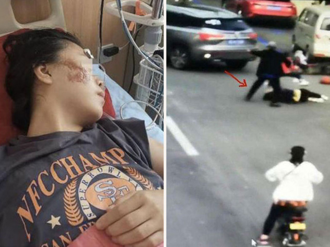 33歲的阿惠遭前男友駕車輾壓，導致全身多處受傷，身上縫合了30多針。（網圖）