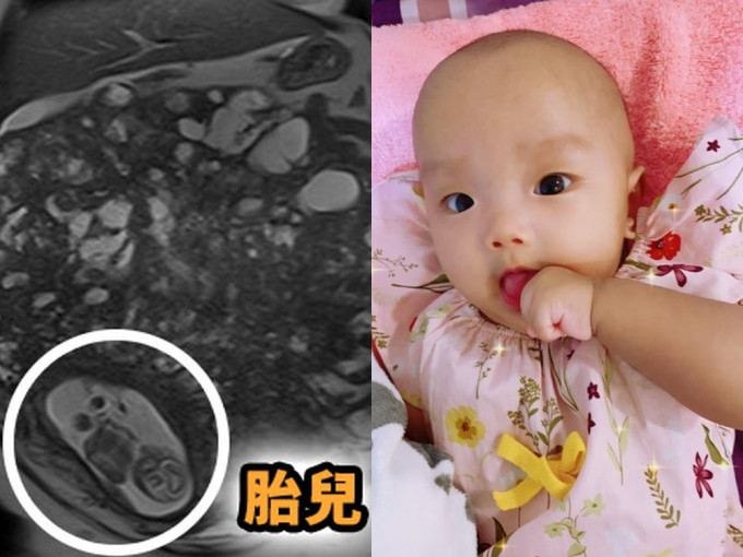 台湾一名孕妈子宫长巨型肌瘤塞满全腹，更曾怀疑是恶性肿瘤，但她坚持捱至35周剖腹产，幸母子平安。(网图)