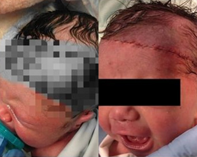 剖腹产子落刀太深，鎅伤初生婴面留疤痕。网上图片
