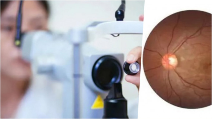 女子染疫發燒3天後，近乎失明，診斷為新冠引致視網膜病變。 微博圖