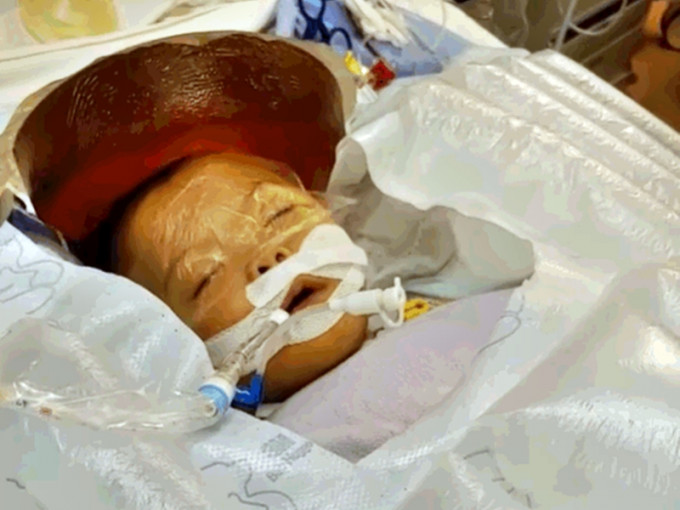 悦悦的母亲表示，女儿体内的阿摩尼亚指数下降，医生指不排除其肝脏有修复中的可能。「Coka.Kona Baby」FB影片截图