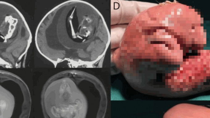 女嬰行動遲緩，一檢查發現大腦裡有她的雙胞胎姊妹。 《神經學》期刊圖片