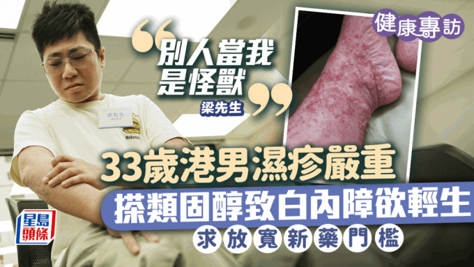 世界濕疹關注日｜33歲港男濕疹嚴重被當怪獸 搽類固醇致白內障欲輕生 求放寬新藥門檻