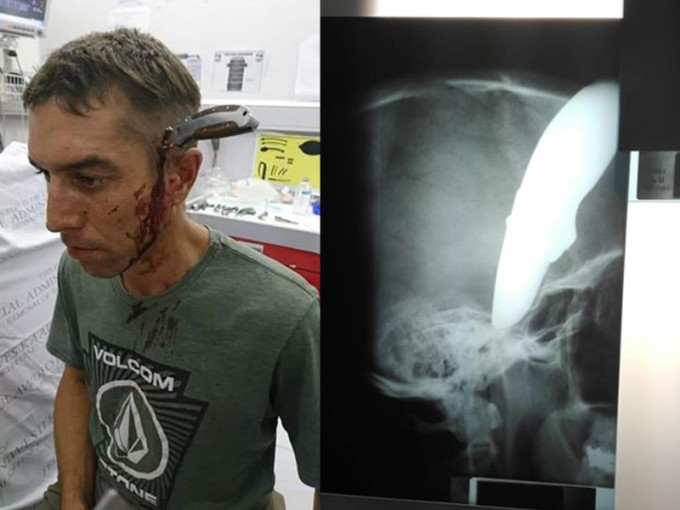 头插15cm长刀，他仍能自行踩单车求诊，因为刀柄在受到撞击力时向下弯曲了转向面颊部位，所以刀子没有伤到脑部。（网图）