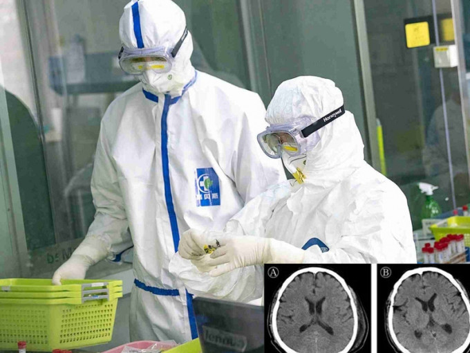 北京地壇醫院首次證實 新冠病毒攻擊中樞神經系統。
