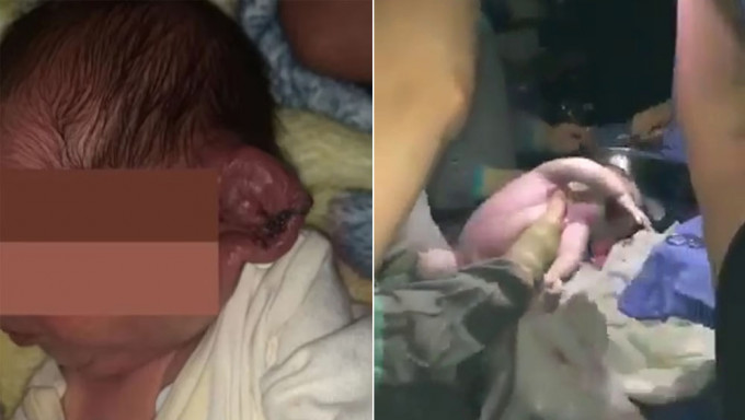 醫院停電醫生堅持手機照明剖腹生產，嬰左耳慘被切斷。網圖