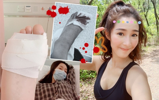 吴嘉仪在社交网发文透露不慎受伤。