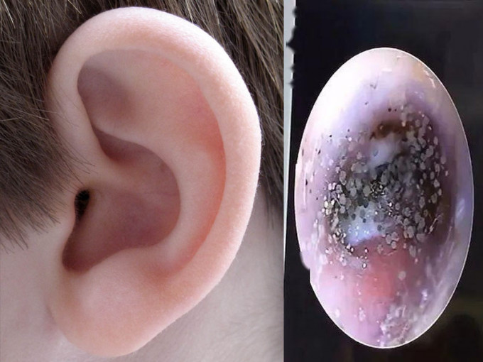 长期佩戴耳机喜挖耳朵 10岁男童耳道犹如一片「黑色森林」。(网图)