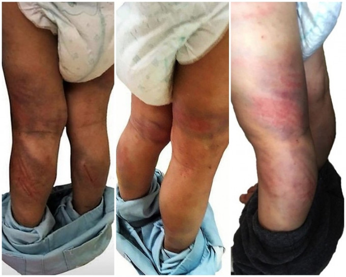 女童一双腿疑被藤条鞭打至多处瘀青。网图