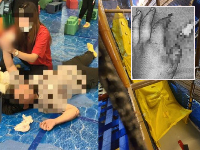 台灣10歲男童玩滑梯， 大拇指慘被尼龍繩切開兩截。