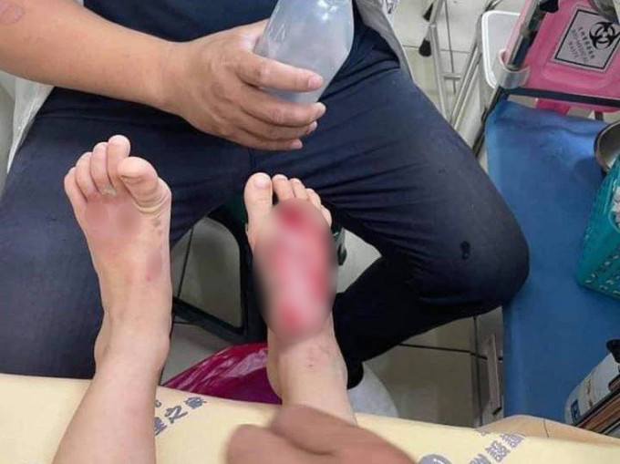 男童脚掌遭渌伤。互联网图片