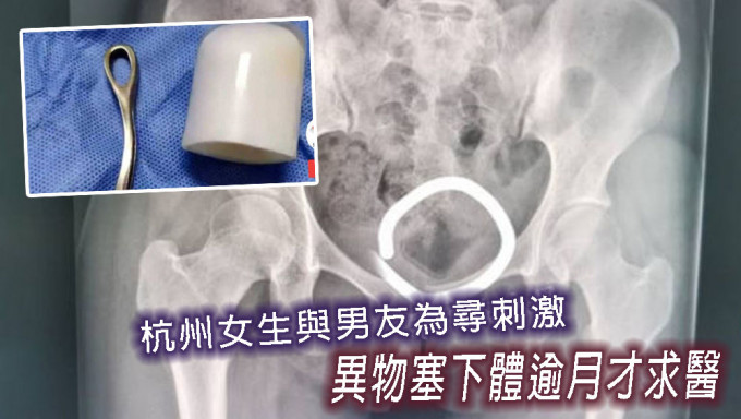 杭州女生異物塞進下體取不出求醫。
