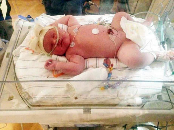 15磅女嬰出生時，體型已相當於一般半歲的嬰兒。