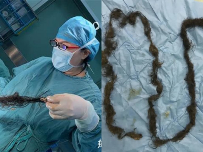 醫生在畸胎瘤拉出長達兩米多的毛髮。網圖