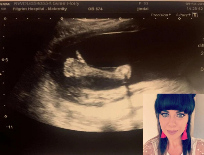 英国一名孕妇照B超惊见男婴肚内竖大姆指。（网图）