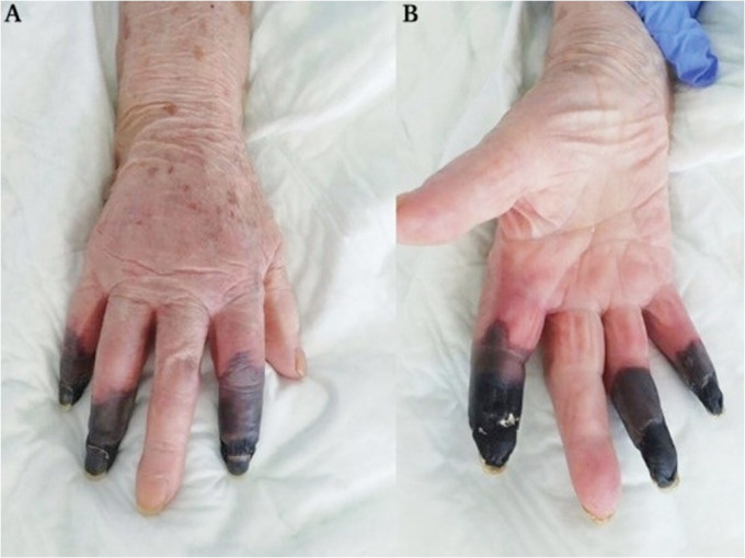 意大利一名婦人感染新冠肺炎後，手指發黑，最終需截肢處理。網圖