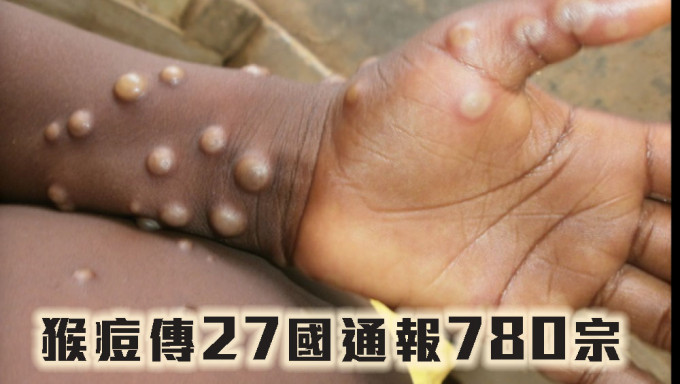 猴痘傳27國通報780宗，世衞維持風險中等。WHO