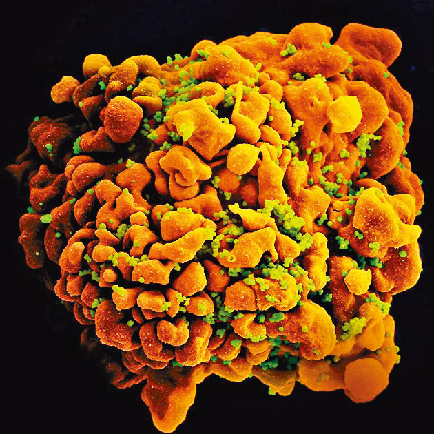 ■电子显微镜显示爱滋病毒攻击人体T细胞。