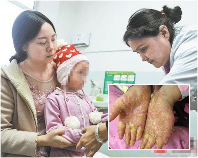 新疆烏魯木齊5歲的美美患上怪病，全身多處脫皮潰爛。網圖
