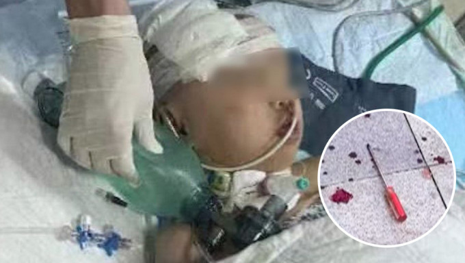惠州6歲女童遭天降螺絲批擊中頭重傷仍昏迷，其父表示女兒恐成植物人。
