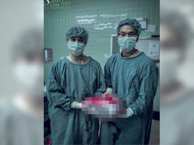 醫生從女童體內切除出長約近2呎的腫瘤。Nath Kaitaphiwasu Fb