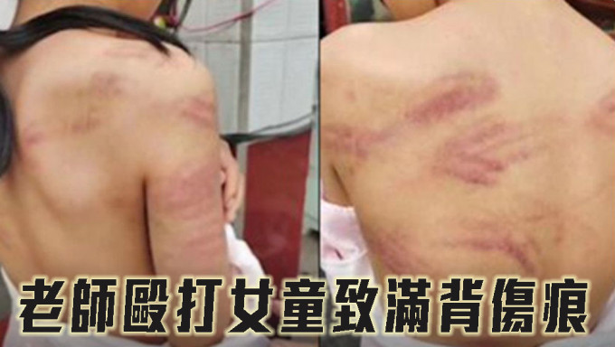 山東一名小學老師毆打女童致滿背傷痕，涉事老師已被刑拘。