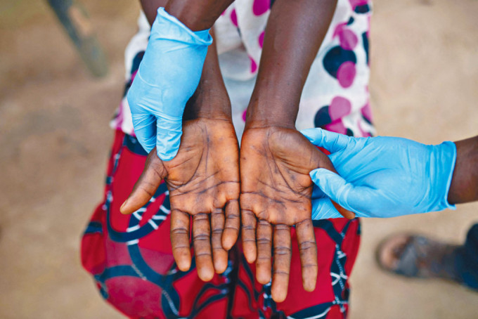 剛果民主共和國猴痘患者展示手部皮膚狀況。
