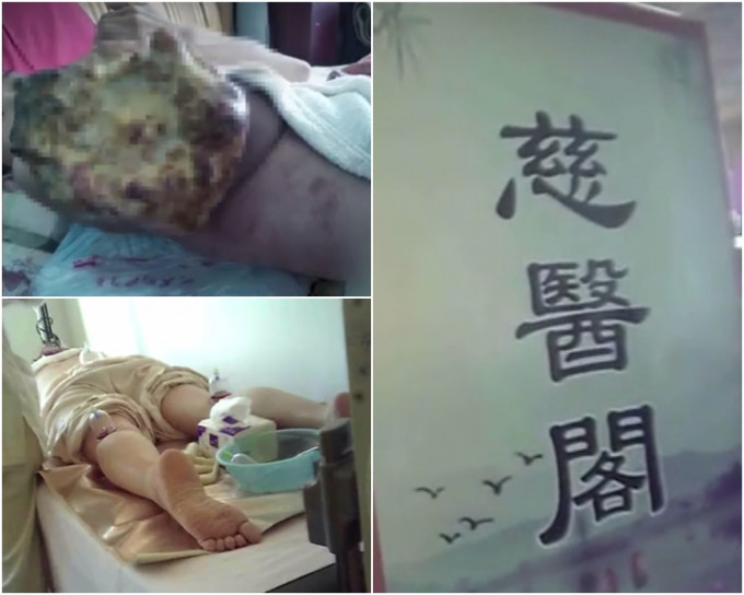 廣州「慈醫閣」中醫館使用「放血療法」，導致病人傷口潰爛、嚴重貧血。影片截圖