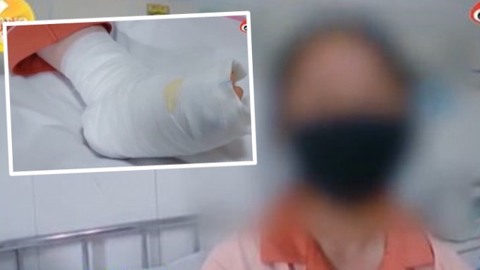 陝西女童使用電毯睡覺時燙傷，手腳仍需敷治。網上影片截圖