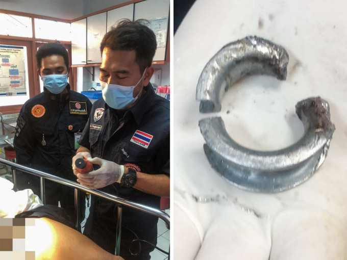 泰國男子為給女友驚喜，螺絲帽卡生殖器腫脹入院須動手術切割螺絲帽。（網圖）