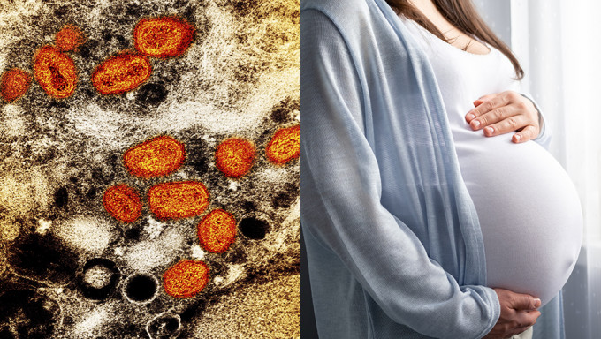 美国发现首宗孕妇猴痘病例，未传染腹中胎儿。AP/iStock图