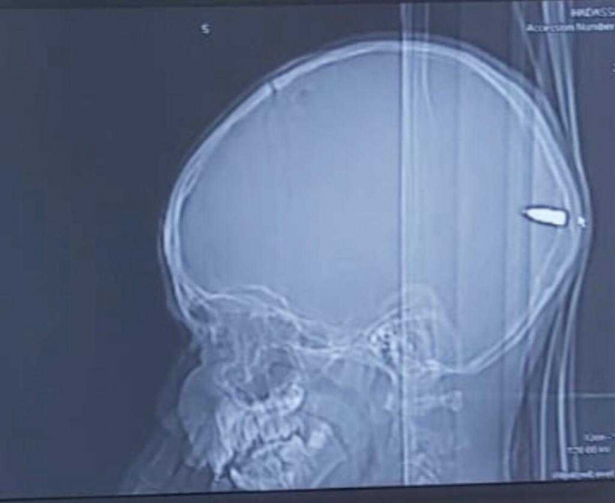 求醫才發現男童腦後顱骨位置卡住一顆子彈。網圖