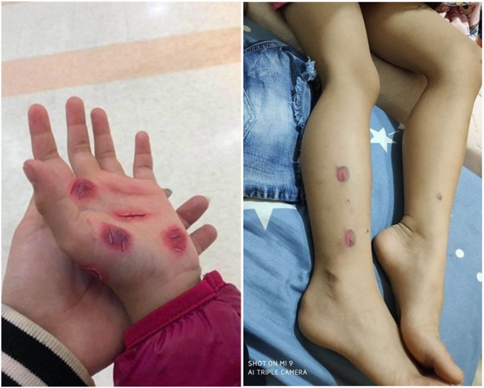 台灣一名5歲女童腿及手上出現自己畫的「傷口」。網上圖片