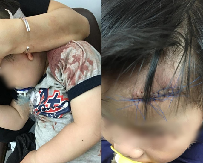 男童撞傷前額，共縫11針。facebook
