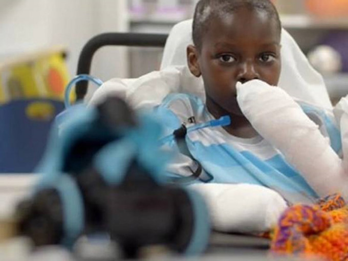 美国10岁男童因新冠肺炎引发「儿童多系统炎症综合症」，被迫接受4次截肢手术，失去双掌与双腿。（网图）